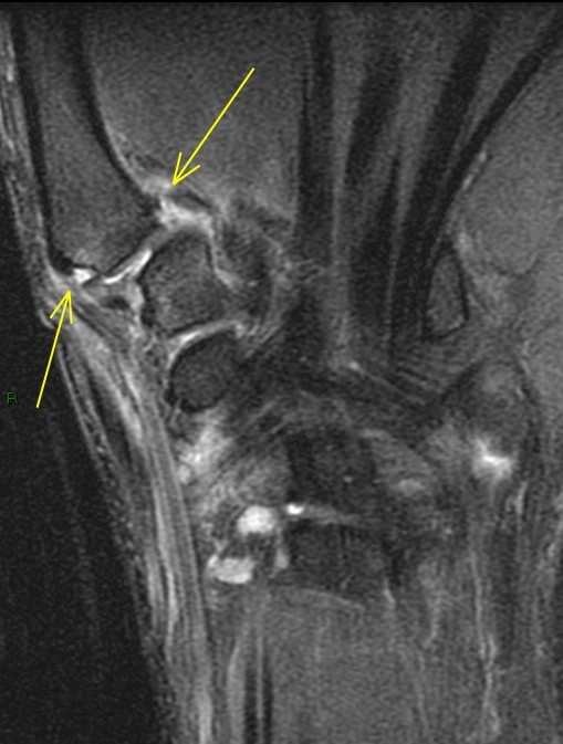 Figure 5 for case trapeziometacarpal dislocation